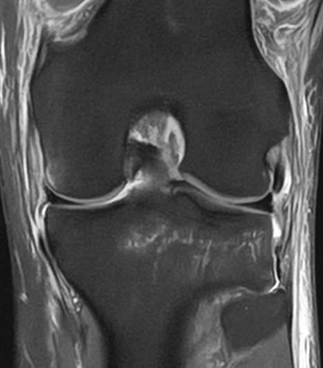 Polven magneettikuva edestä